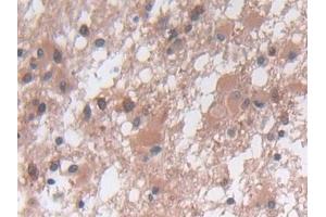 Detection of MMP23B in Human Glioma Tissue using Polyclonal Antibody to Matrix Metalloproteinase 23B (MMP23B) (MMP23B anticorps  (AA 79-390))