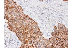 IHC-P Image Immunohistochemical analysis of paraffin-embedded Lung CA, using Cytokeratin 14, antibody at 1:100 dilution. (KRT14 anticorps)