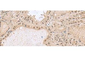 Immunohistochemistry of paraffin-embedded Human thyroid cancer tissue using PCLAF Polyclonal Antibody at dilution of 1:50(x200) (KIAA0101 anticorps)