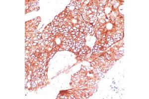 Immunohistochemistry of paraffin-embedded human colon carcinoma using FA antibody (ABIN7267121) at dilution of 1:100 (40x lens).