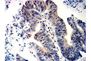 Immunohistochemical analysis of paraffin-embedded colon cancer tissues using WT1 mouse mAb with DAB staining. (WT1 anticorps  (AA 1-181))