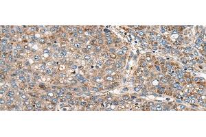 Immunohistochemistry of paraffin-embedded Human liver cancer tissue using CADM2 Polyclonal Antibody at dilution of 1:40(x200)