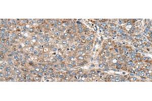 Immunohistochemistry of paraffin-embedded Human liver cancer tissue using CADM2 Polyclonal Antibody at dilution of 1:40(x200) (CADM2 anticorps)