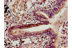 Immunohistochemistry of paraffin-embedded human lung cancer using ABIN7147907 at dilution of 1:100 (Claudin 5 anticorps  (AA 181-218))