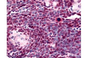 Anti-NR2E1 / TLX antibody IHC of human Lung, Small Cell Carcinoma.