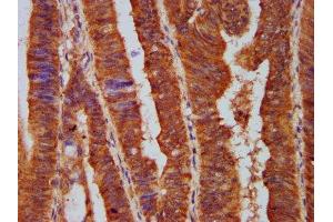 IHC image of ABIN7169254 diluted at 1:500 and staining in paraffin-embedded human colon cancer performed on a Leica BondTM system.