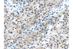 The image on the left is immunohistochemistry of paraffin-embedded Human breast cancer tissue using ABIN7131359(TKT Antibody) at dilution 1/30, on the right is treated with fusion protein. (TKT anticorps)