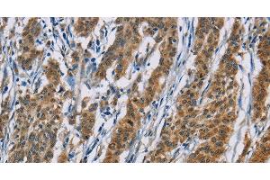 Immunohistochemistry of paraffin-embedded Human gasrtic cancer tissue using ACVR1 Polyclonal Antibody at dilution 1:60 (ACVR1 anticorps)