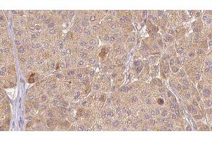 ABIN6277349 at 1/100 staining Human Melanoma tissue by IHC-P. (CTGF anticorps  (Internal Region))