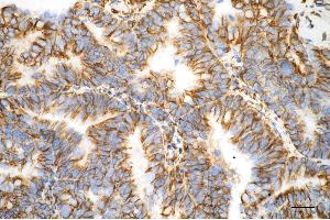 Immunohistochemistry was performed on paraffin-embedded human endometrial carcinoma using vimentin antibody (ABIN7800840), 1:100).