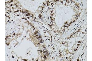 Immunohistochemistry of paraffin-embedded human gastric cancer using DCK antibody (ABIN5970907) at dilution of 1/100 (40x lens). (DCK anticorps)