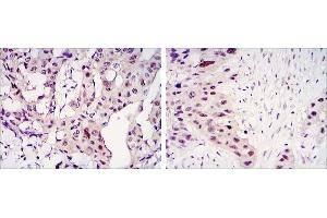 Immunohistochemical analysis of paraffin-embedded mammary cancer tissues (left) and lung cancer tissues (right) using STAT3 antibody with DAB staining. (STAT3 anticorps)