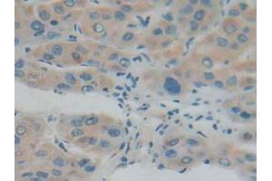 IHC-P analysis of Human Liver Cancer Tissue, with DAB staining. (IFNAR1 anticorps  (AA 28-227))