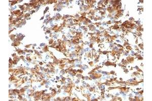 Formalin-fixed, paraffin-embedded human melanoma stained with anti-Vimentin antibody (VM1170). (Vimentin anticorps)