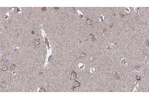ABIN6276617 at 1/100 staining Human brain cancer tissue by IHC-P. (SRPX anticorps)