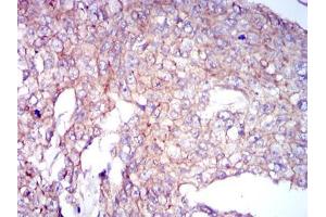 Immunohistochemical analysis of paraffin-embedded breast cancer tissues using COTL1 mouse mAb with DAB staining. (COTL1 anticorps)