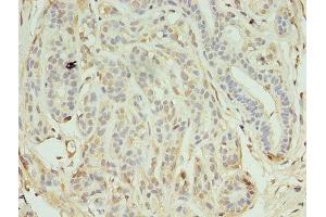 Immunohistochemistry of paraffin-embedded human breast cancer using ABIN7157263 at dilution of 1:100 (KEAP1 anticorps  (AA 1-624))
