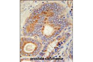 HHAT Antibody immunohistochemistry analysis in formalin fixed and paraffin embedded human prostate carcinoma followed by peroxidase conjugation of the secondary antibody and DAB staining.
