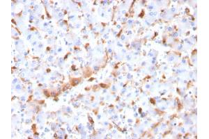 Formalin-fixed, paraffin-embedded human Hepatocellular Carcinoma stained with C1QB Mouse Monoclonal Antibody (C1QB/2966).