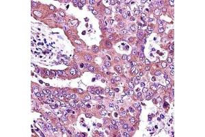 JAK2 antibody immunohistochemistry analysis in formalin fixed and paraffin embedded human lung adenocarcinoma.