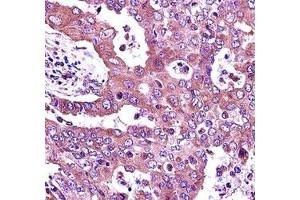 JAK2 antibody immunohistochemistry analysis in formalin fixed and paraffin embedded human lung adenocarcinoma. (JAK2 anticorps  (AA 666-694))