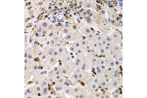 Immunohistochemistry of paraffin-embedded human liver cancer using BCL11A antibody at dilution of 1:200 (400x lens). (BCL11A anticorps)
