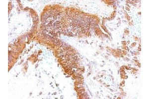 IHC-P Image GEM antibody [N1], N-term detects GEM protein at membrane on human lung by immunohistochemical analysis. (GEM anticorps  (N-Term))