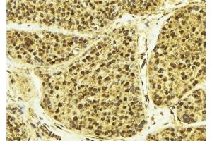 ABIN6268947 at 1/100 staining Human breast cancer tissue by IHC-P. (DREAM anticorps  (Internal Region))