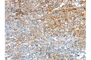 The image on the left is immunohistochemistry of paraffin-embedded Human ovarian cancer tissue using ABIN7192909(TRIM47 Antibody) at dilution 1/30, on the right is treated with synthetic peptide. (TRIM47 anticorps)