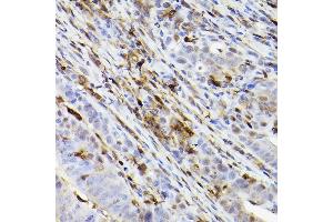 Immunohistochemistry of paraffin-embedded human colon carcinoma using Ferritin Heavy Chain Rabbit mAb (ABIN7267168) at dilution of 1:100 (40x lens).