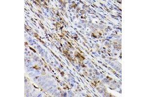 Immunohistochemistry of paraffin-embedded human colon carcinoma using Ferritin Heavy Chain Rabbit mAb (ABIN7267168) at dilution of 1:100 (40x lens). (FTH1 anticorps)