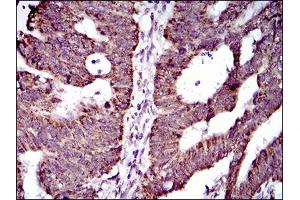 Immunohistochemical analysis of paraffin-embedded rectum cancer tissues using ABCG5 mouse mAb with DAB staining.
