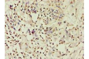 Immunohistochemistry of paraffin-embedded human breast cancer using ABIN7143182 at dilution of 1:100