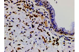 ABIN6267443 at 1/200 staining human glioma tissue sections by IHC-P.