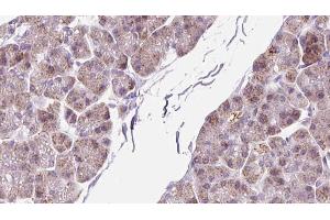 ABIN6273299 at 1/100 staining Human pancreas cancer tissue by IHC-P.