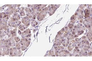 ABIN6273299 at 1/100 staining Human pancreas cancer tissue by IHC-P. (PMM2 anticorps  (C-Term))