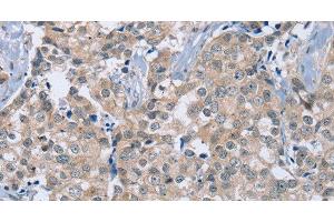Immunohistochemistry of paraffin-embedded Human breast cancer using RAB8B Polyclonal Antibody at dilution of 1:40 (RAB8B anticorps)