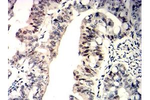 Immunohistochemical analysis of paraffin-embedded rectum cancer tissues using WT1 mouse mAb with DAB staining. (WT1 anticorps  (AA 1-181))