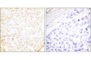Immunohistochemistry analysis of paraffin-embedded human breast carcinoma tissue, using XRCC5 Antibody. (X-Ray Repair Cross Complementing 5 (AA 683-732) anticorps)