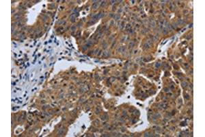 The image on the left is immunohistochemistry of paraffin-embedded Human ovarian cancer tissue using ABIN7192614(SPAG4 Antibody) at dilution 1/50, on the right is treated with synthetic peptide. (SPAG4 anticorps)