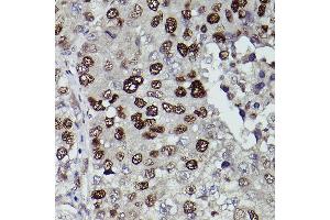 Immunohistochemistry of paraffin-embedded human liver cancer using KDM3A Rabbit pAb (ABIN6134725, ABIN6142790, ABIN6142791 and ABIN6215526) at dilution of 1:150 (40x lens).