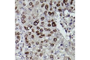 Immunohistochemistry of paraffin-embedded human liver cancer using KDM3A Rabbit pAb (ABIN6134725, ABIN6142790, ABIN6142791 and ABIN6215526) at dilution of 1:150 (40x lens). (KDM3A anticorps  (AA 350-450))