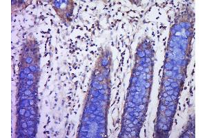 Paraformaldehyde-fixed, paraffin embedded human colon cancer, Antigen retrieval by boiling in sodium citrate buffer (pH6.