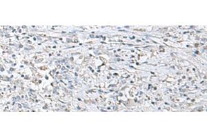 Immunohistochemistry of paraffin-embedded Human liver cancer tissue using EPM2A Polyclonal Antibody at dilution of 1:55(x200)