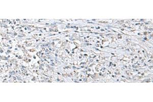 Immunohistochemistry of paraffin-embedded Human liver cancer tissue using EPM2A Polyclonal Antibody at dilution of 1:55(x200) (EPM2A anticorps)