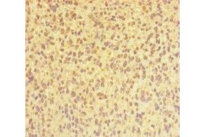 Immunohistochemistry of paraffin-embedded human glioma using ABIN7147689 at dilution of 1:100 (CHTOP anticorps  (AA 179-248))