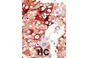 Formalin-fixed and paraffin-embedded human hepatocellular carcinoma tissue reacted with the ACSL4 polyclonal antibody  , which was peroxidase-conjugated to the secondary antibody, followed by DAB staining. (ACSL4 anticorps  (AA 244-274))