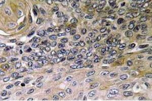 Immunohistochemistry (IHC) analyzes of IL-8 antibody in paraffin-embedded human lung carcinoma tissue. (IL-8 anticorps)