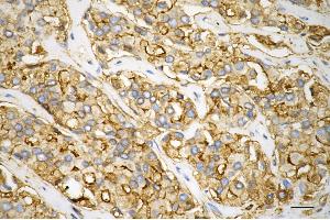 Immunohistochemistry was performed on paraffin-embedded human prostatic adenocarcinoma using annexin A5 antibody (ABIN7797621), 1:100).