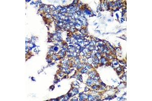 Immunohistochemistry of paraffin-embedded Human colon carcinoma using ESPN Rabbit pAb (ABIN7267008) at dilution of 1:100 (40x lens).